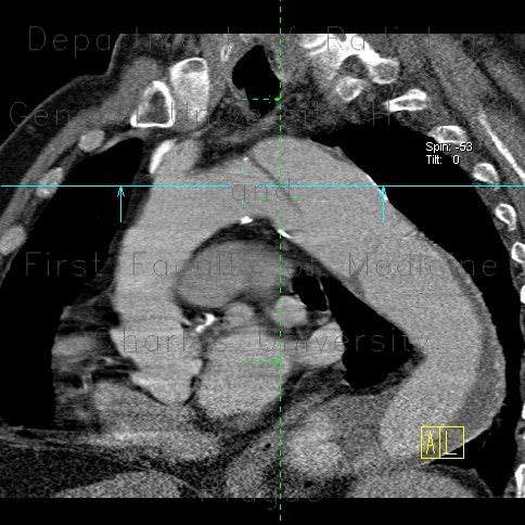 Aortic dissection, Standford B, dissecting aneurysm, re-entry