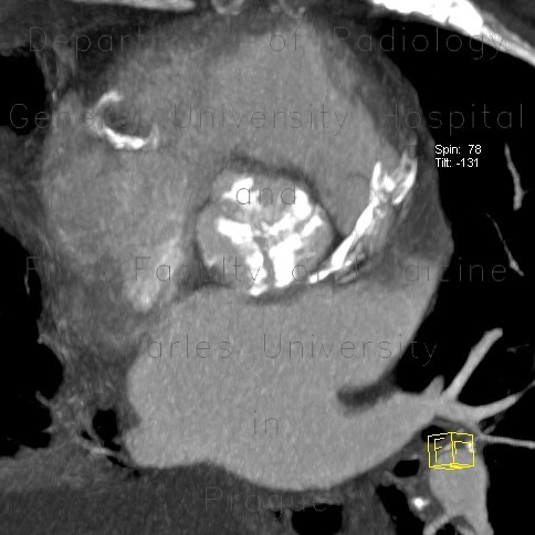 Radiology image - Aortic valve, calcified aortic valve: Thorax, Heart: CT - Computed tomography