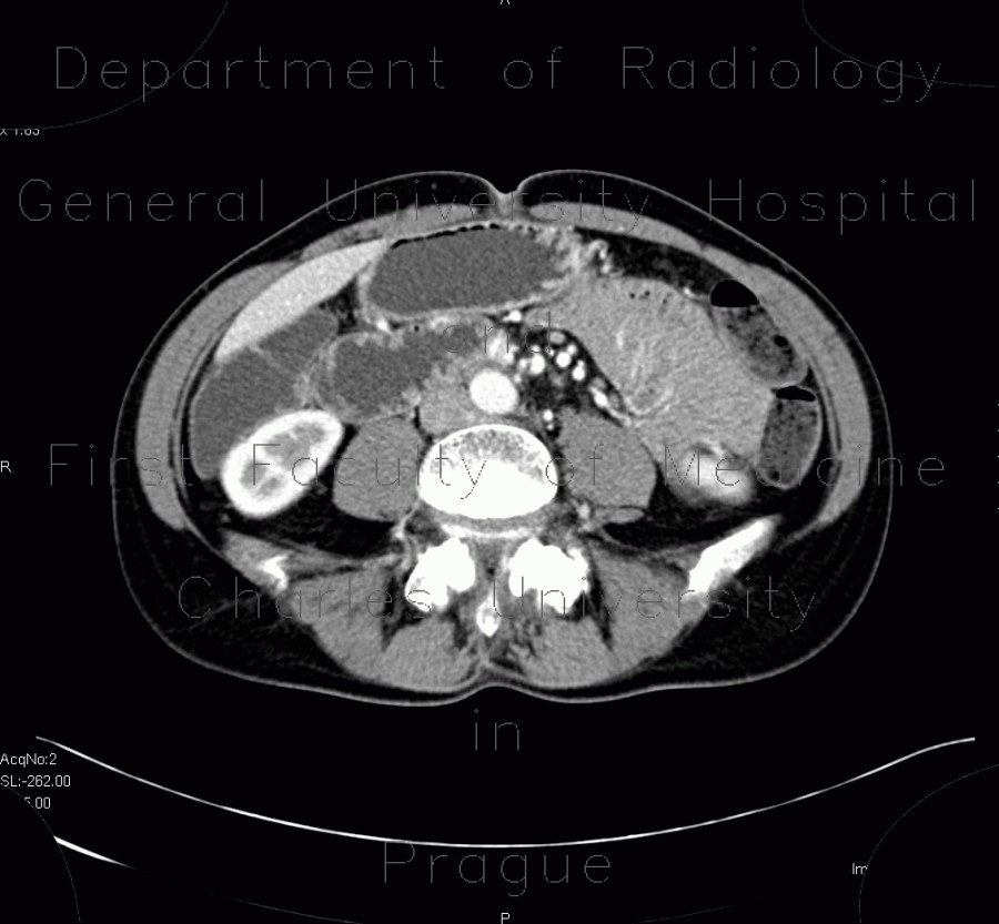 Radiology image - Aortomesenteric compression, SMA syndrome, superior mesenteric artery: Abdomen, Small bowel: CT - Computed tomography
