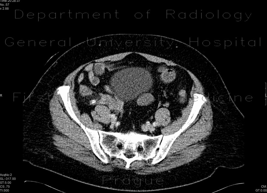 Appendicitis, appendicolith