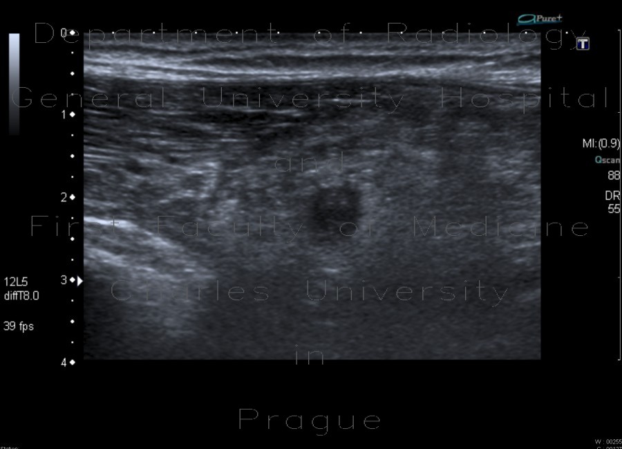 Appendicitis, gangrenous appendicitis