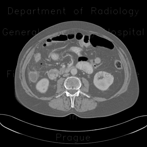 Radiology image - Appendicitis, gangrenous appendicitis, gangrene: Abdomen, Large bowel, Peritoneal cavity: CT - Computed tomography