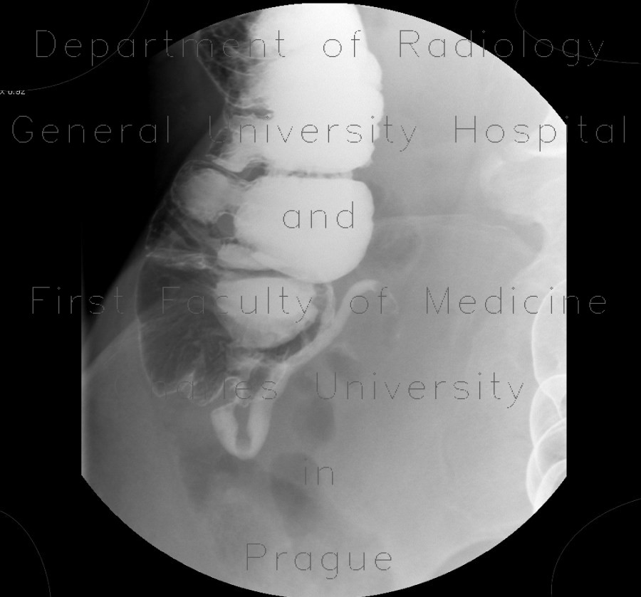 Radiology image - Appendicography, appendicolith, fecal stone: Abdomen, Large bowel: RF - Fluoroscopy