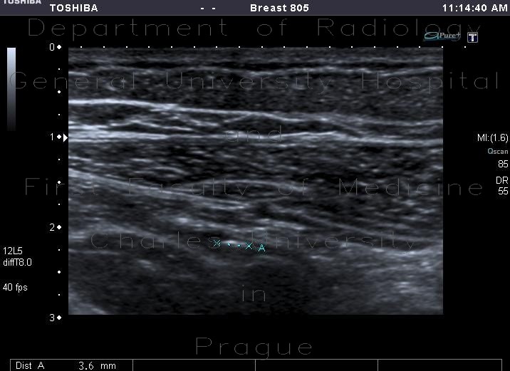 Radiology image - Appendicolith: Abdomen, Large bowel: US - Ultrasound