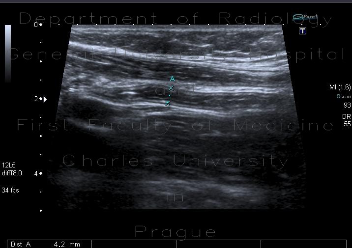 Appendix, normal appearance