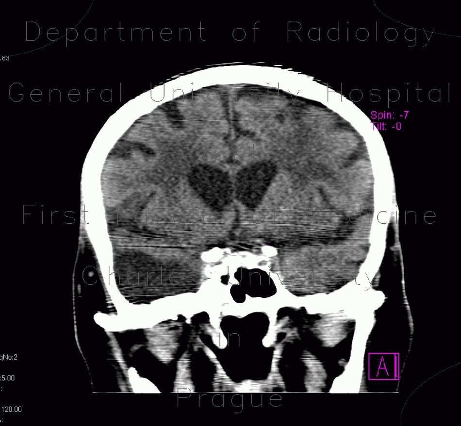 Arachnoidal cyst
