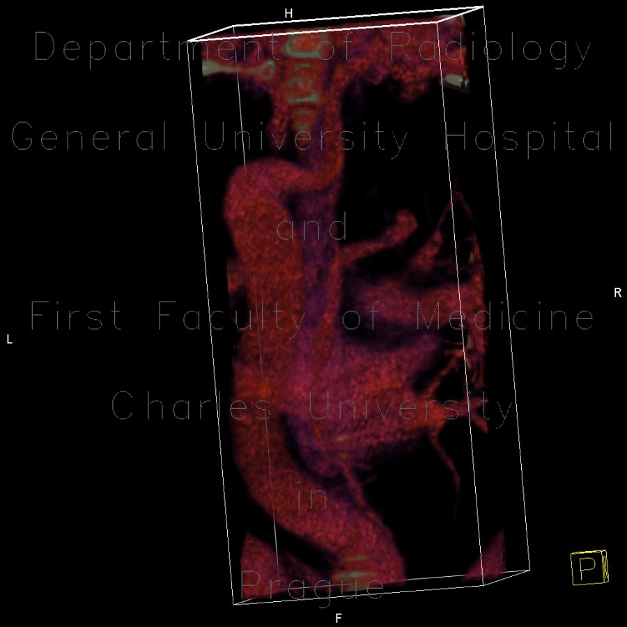 Arteria lusoria, anomally of the subclavian artery, right