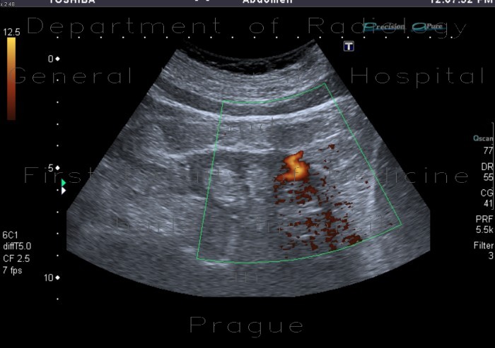 Arteriovenous malformation of kidney