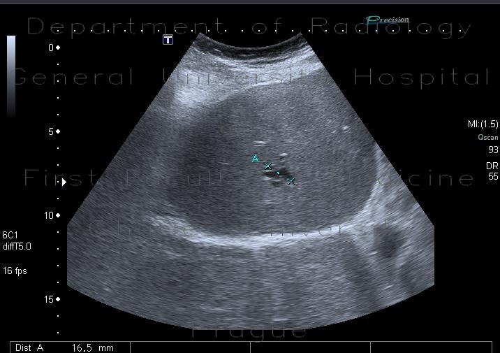 Radiology image - Arteriovenous malformation of liver, AV malformation: Abdomen, Liver: US - Ultrasound
