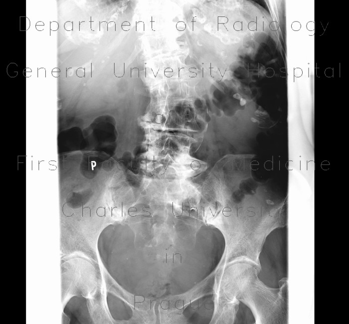 Arthrosis of SI joint