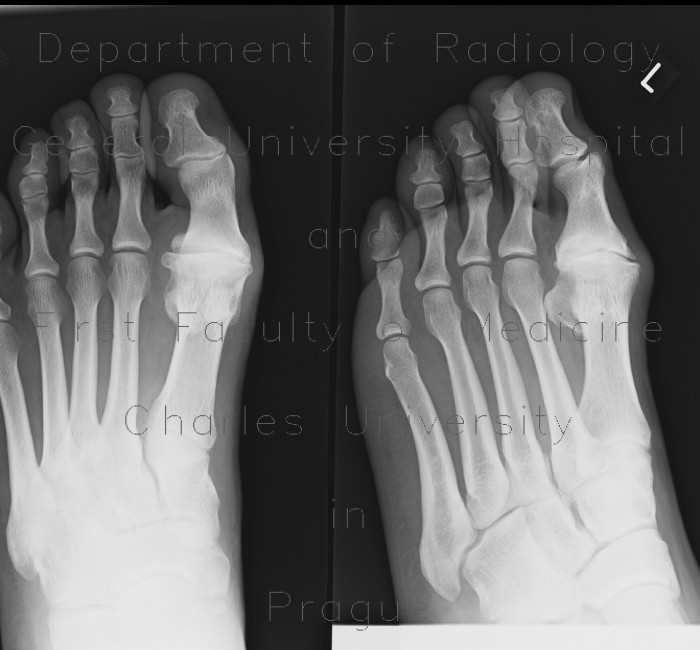 Arthrosis of metatarsophalangeal joint, I. MTP