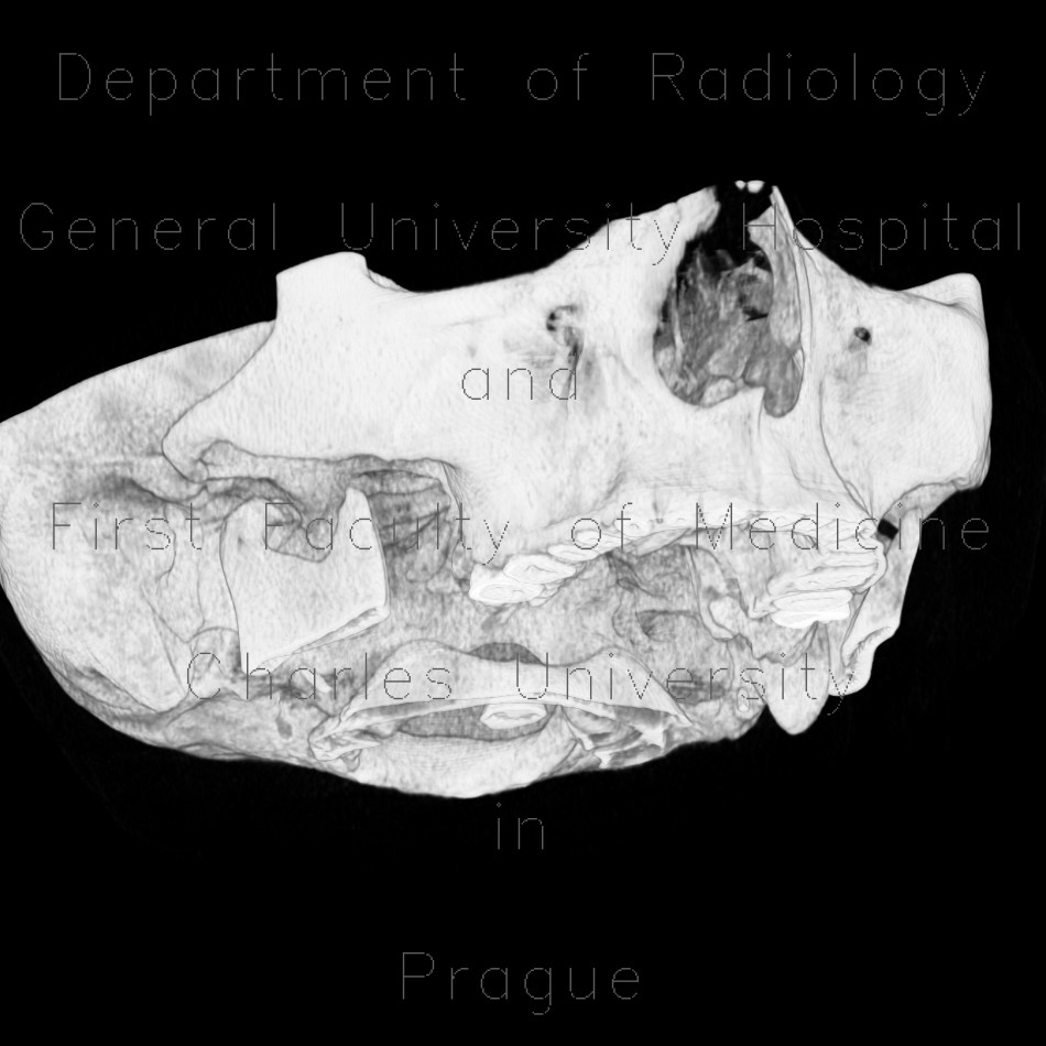 Arthrosis of temporomandibular joint, TMJ