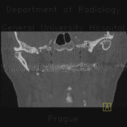 Radiology image - Arthrosis of temporomandibular joint, osteoarthritis: Head and Neck, Bone: CT - Computed tomography