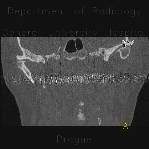 Arthrosis of temporomandibular joint, osteoarthritis