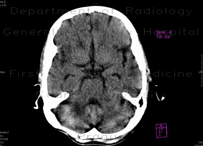 Artifact of posterior cranial fossa on CT (H32S)