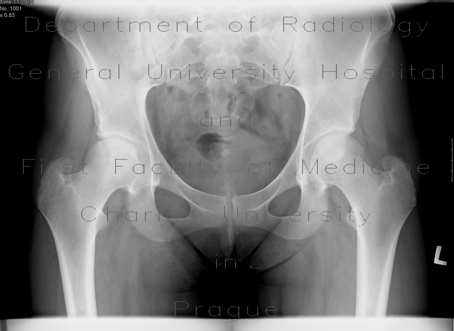 Aseptic necrosis of femoral head