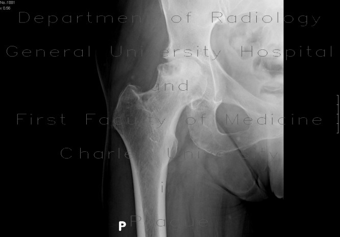 Radiology image - Aseptic necrosis of the femoral head: Extremity, Bone: X-ray - Plain radiograph