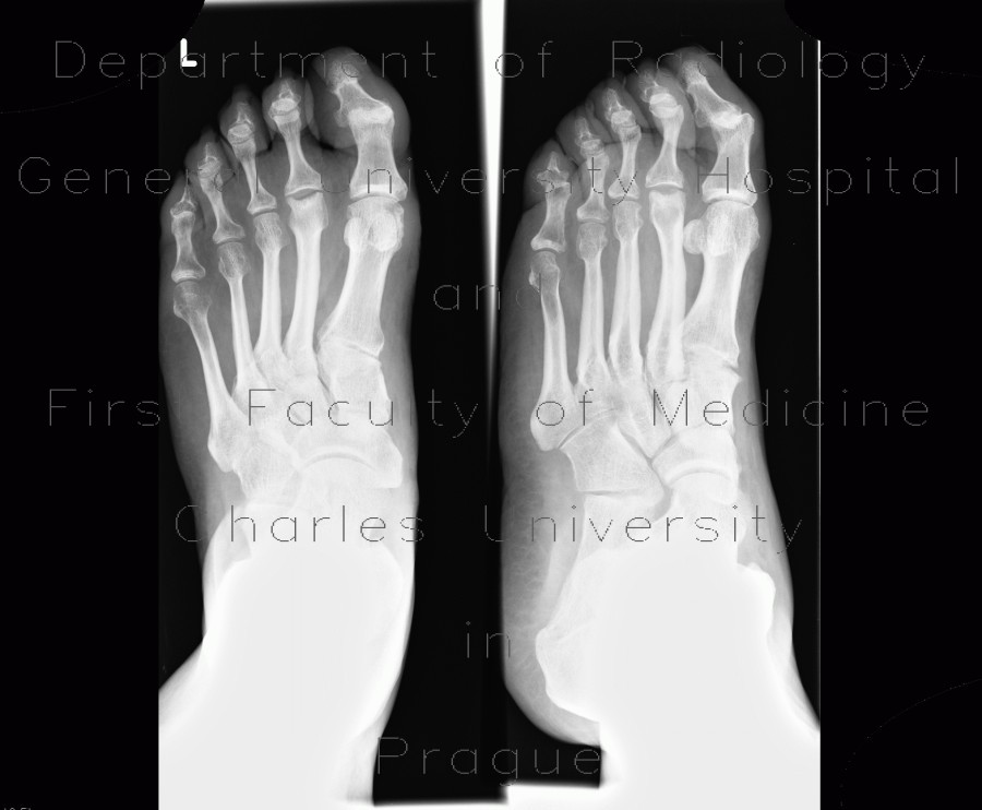 Aseptic necrosis of the head of second metatarsal bone, Freiberg-Kohler disease