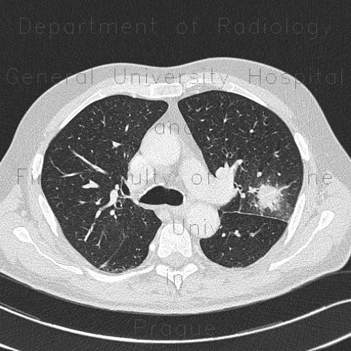 Radiology image - Aspergilloma, aspergillosis, angio-invasive aspergillosis, doubling time, initial scan: Thorax, Lung: CT - Computed tomography