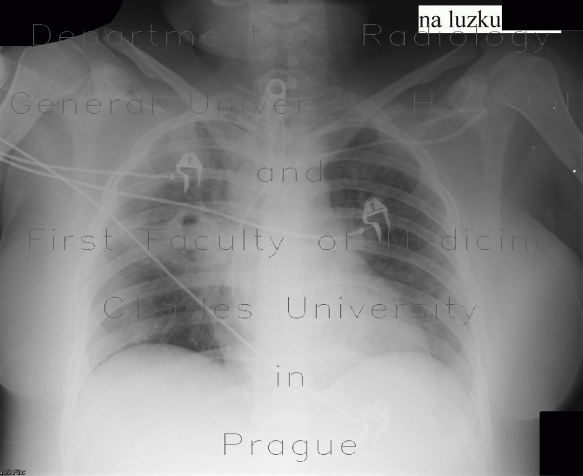 Radiology image - Aspergilosis of the lung: Thorax, Lung: X-ray - Plain radiograph