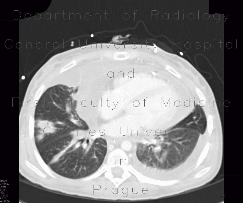 Aspergilosis of the lung, pericardial effusion, mediastinal lymphoma