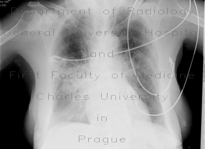 Radiology image - Aspiration pneumonia: Thorax, Lung: X-ray - Plain radiograph