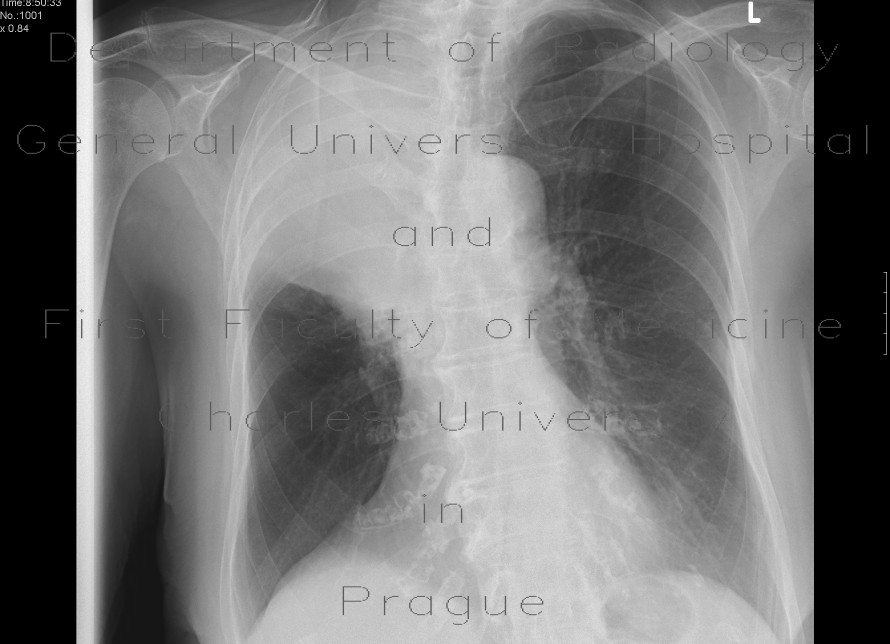 Atelectasis and tumorous infiltration of right upper lobe