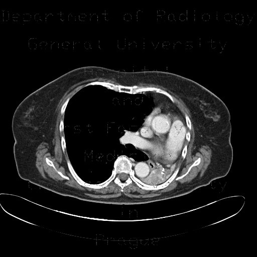 Atelectasis of left lung wing