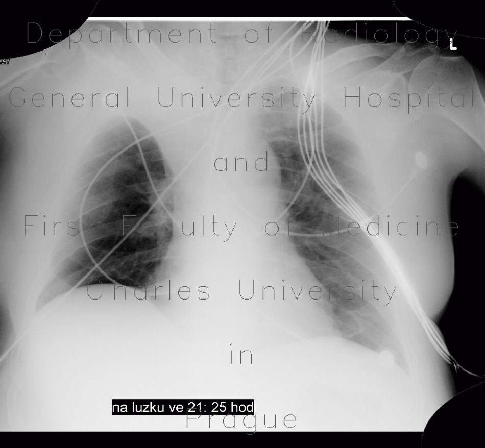 Atelectasis of right upper lobe of lung