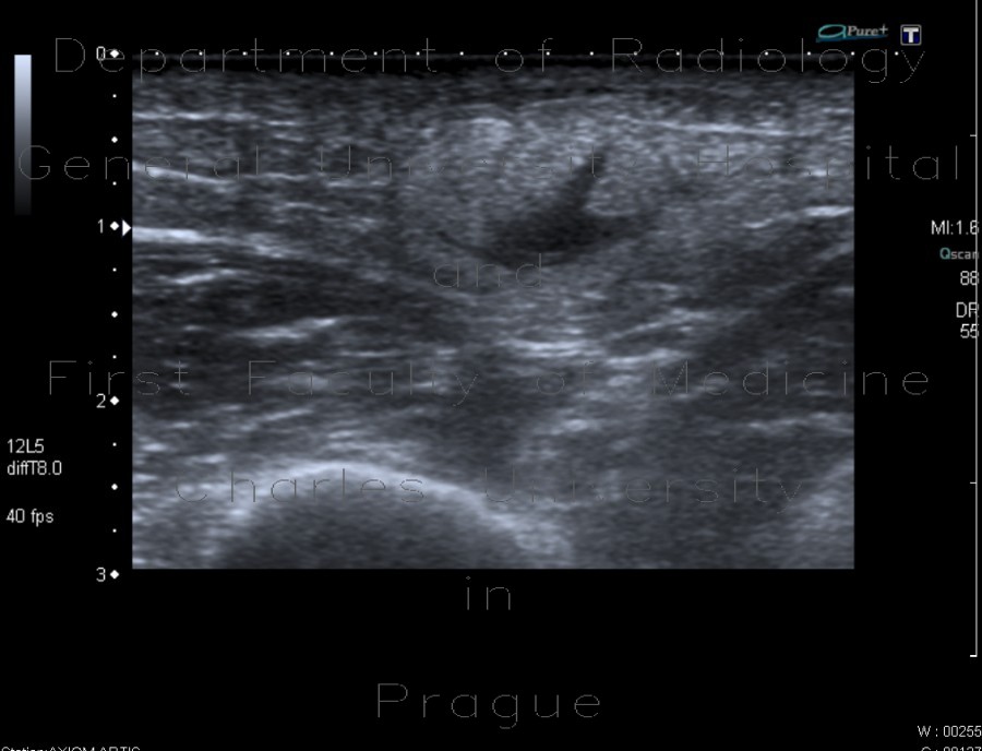 Radiology image - Atheroma, arm: Extremity, Soft tissue: US - Ultrasound