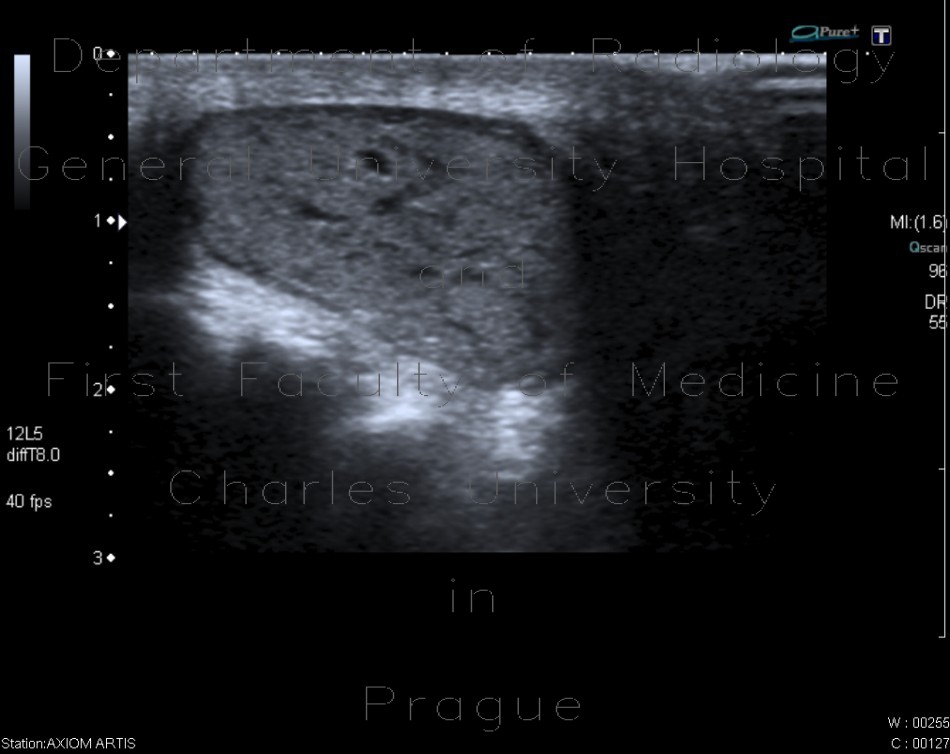 Atheroma in intergluteal cleft