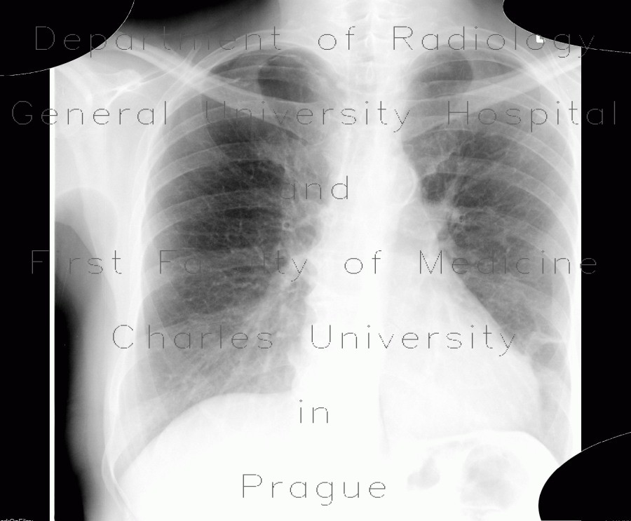 Atherosclerosis, subclavian artery