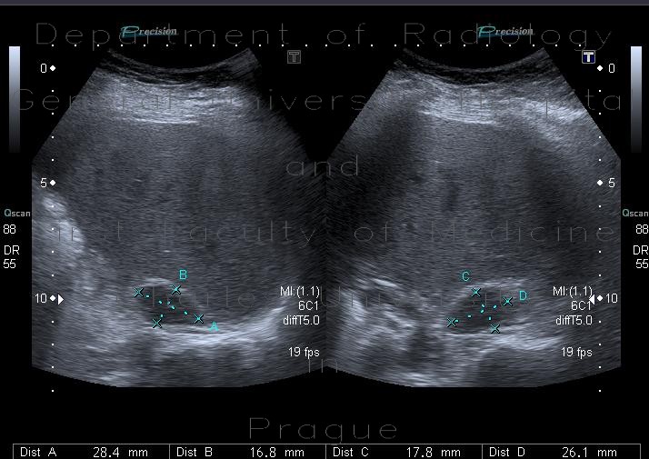 Radiology image - Atypical hemangioma: Abdomen, Liver: US - Ultrasound