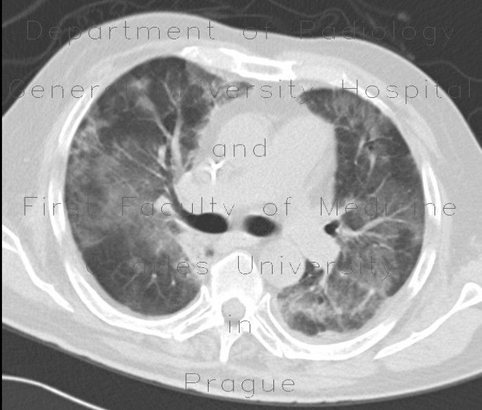 Radiology image - Atypical pneumonia: Thorax, Lung: CT - Computed tomography