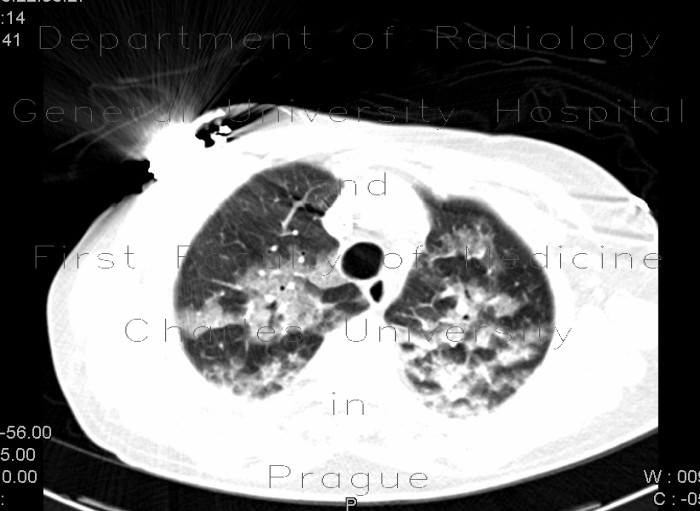 Radiology image - Atypical pneumonia: Thorax, Lung: CT - Computed tomography
