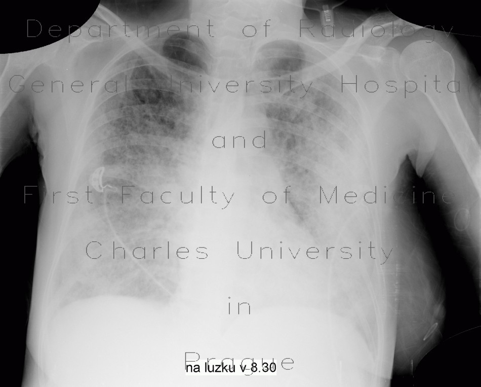 Atypical pneumonia