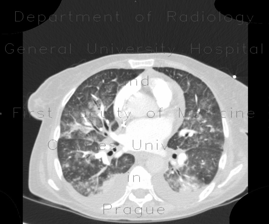 Radiology image - Atypical pneumonia, Pneumocystis pneumonia, PCP: Thorax, Lung: CT - Computed tomography