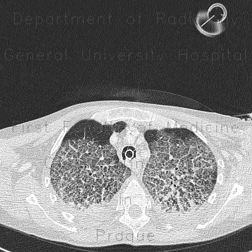 Radiology image - Atypical pneumonia, crazy-paving pattern: Thorax, Lung: CT - Computed tomography