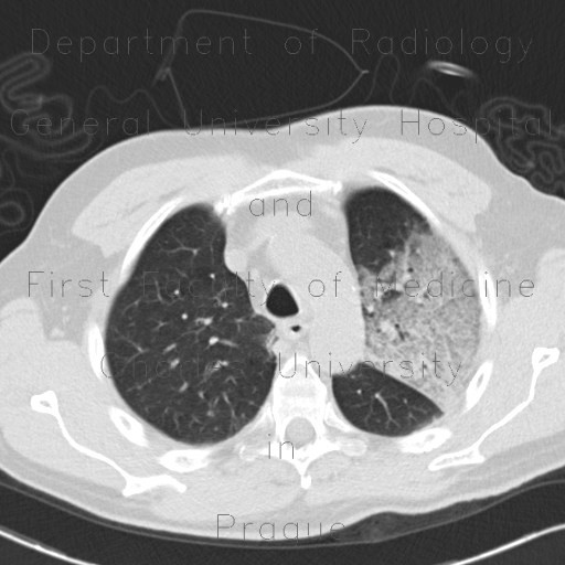 Radiology image - Atypical pneumonia, influenza, H1N1: Thorax, Lung: CT - Computed tomography