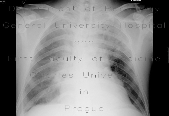 Atypical pneumonia, pleural effusion