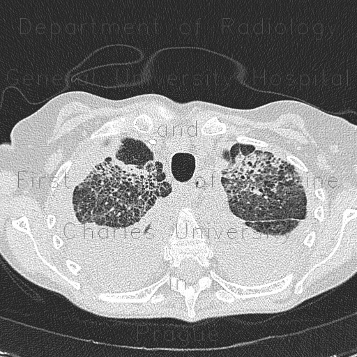 Atypical pneumonia, subacute stage, lung fibrosis