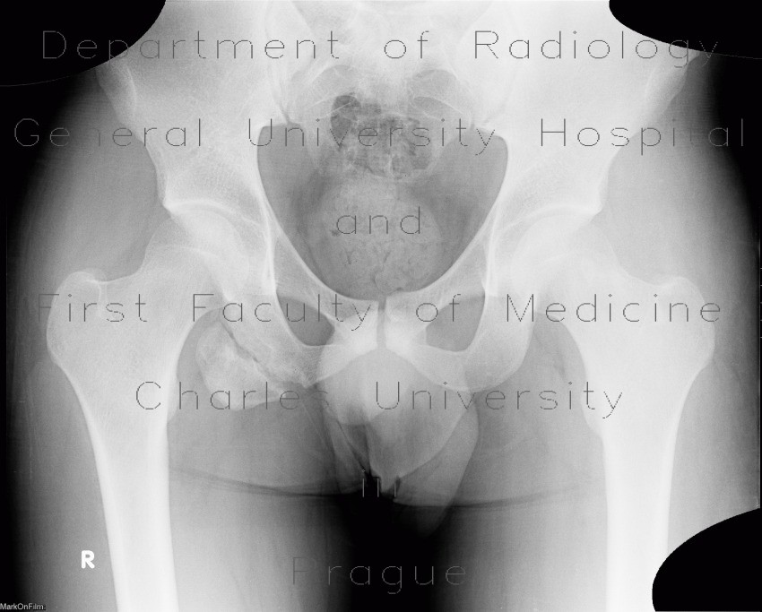 Avulsion of ischial tuberosity