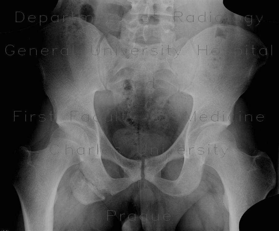 Avulsion of tuber ischiadicum, old