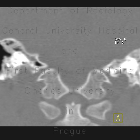 Radiology image - Axis, C2, development of vertebra: Spine and Axial, Bone: CT - Computed tomography