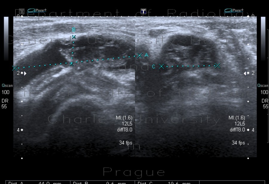 Baker's cyst, rupture