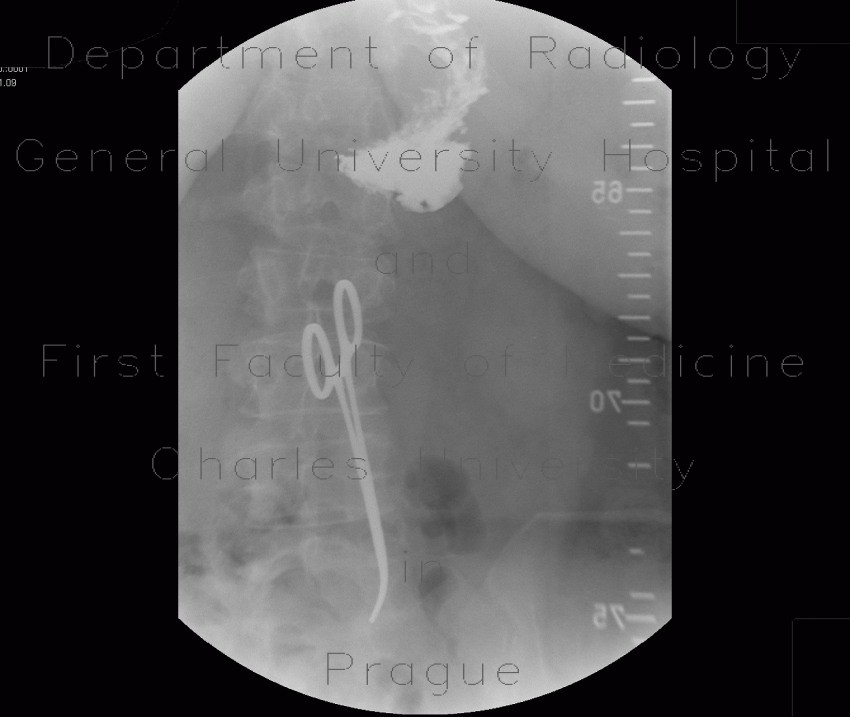 Radiology image - Bariatric surgery, pean: Abdomen, Stomach: RF - Fluoroscopy