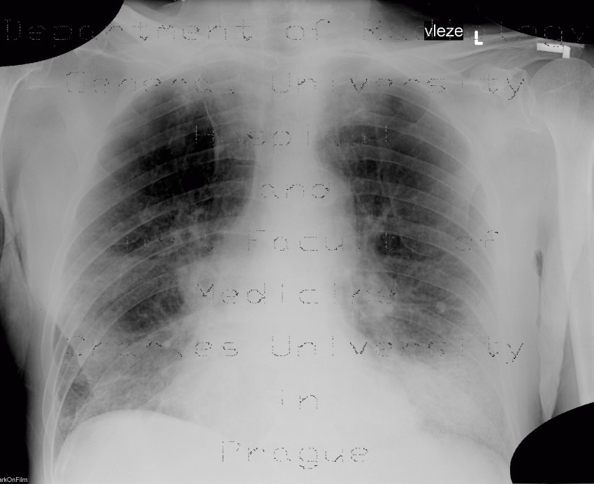 Basal bronchopneumonia