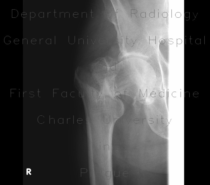 Basicervical fracture of femur