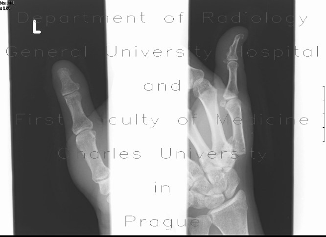 Bennett's fracture