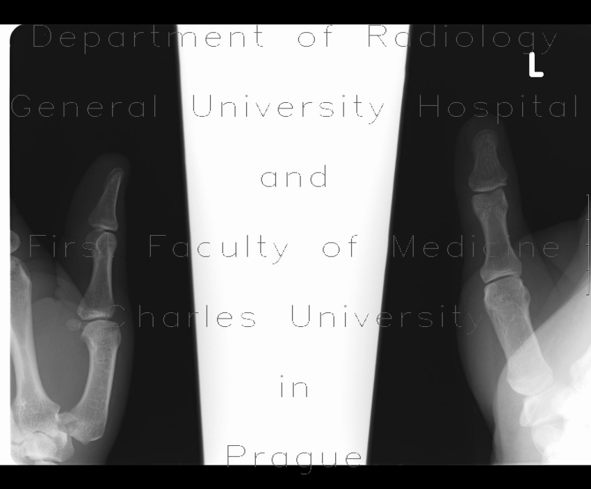 Bennett's fracture